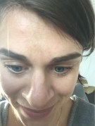 Tough to appreciate but lots of blackheads on and around the nose.