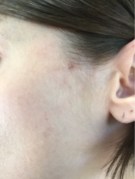 Some small blemishes on the left cheek.