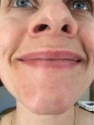 Tough to appreciate but blemishes and enlarged pores on the chin.